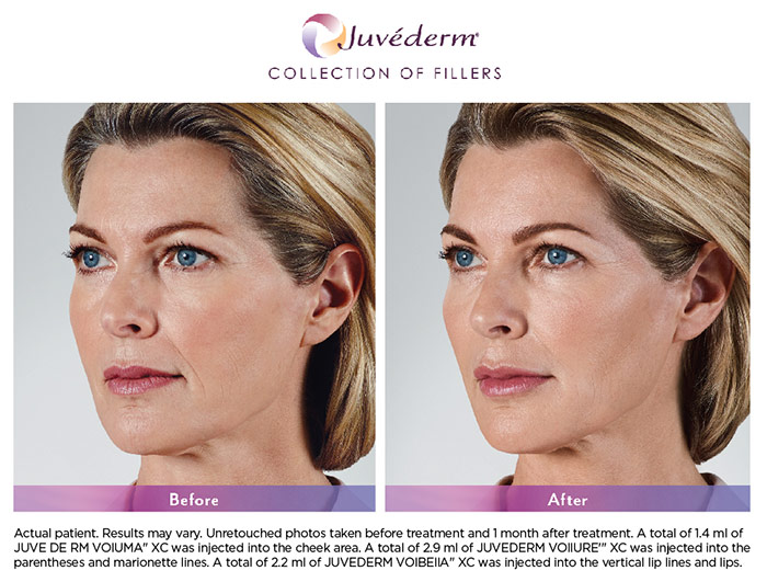 JuvÉderm Fillers Skin Rx Boston 