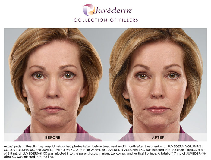 The 45-Second Trick For What Is Juvederm® Treatment? - Forefront Dermatology thumbnail